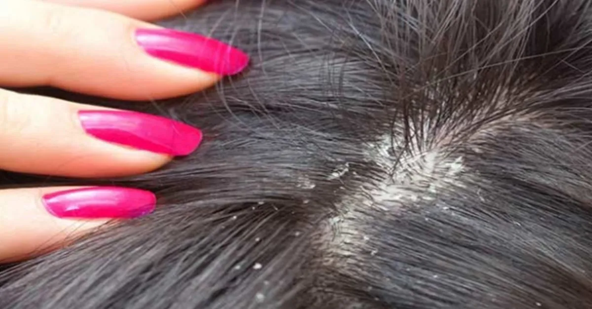 kepek nedir ve nasil olusur kepek