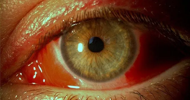 Pakistan’da kırmızı göz salgını hızla yayılıyor Pakistan’da kırmızı göz salgını hızla yayılıyor