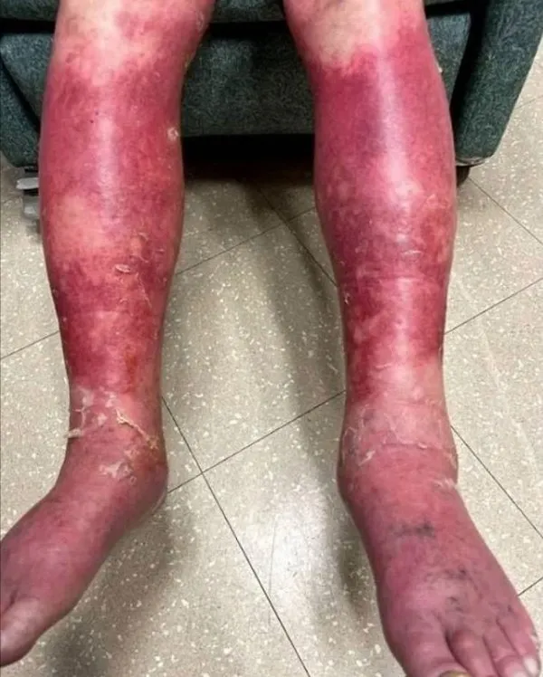 ABD’de koronavirüse karşı yapılan Johnson and Johnson aşısı bu hale getirdi