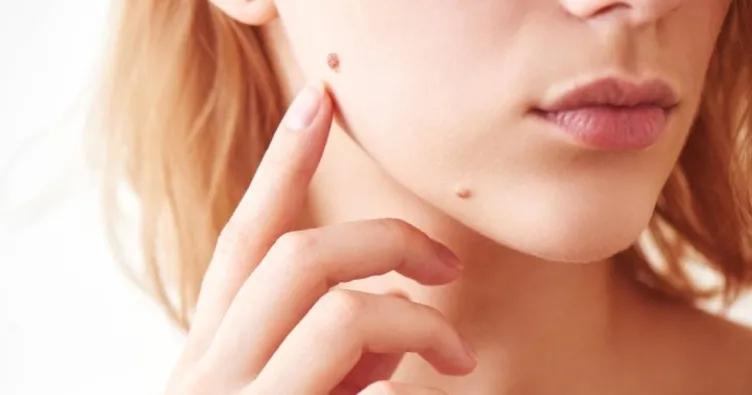 Bu durum cilt kanseri habercisi