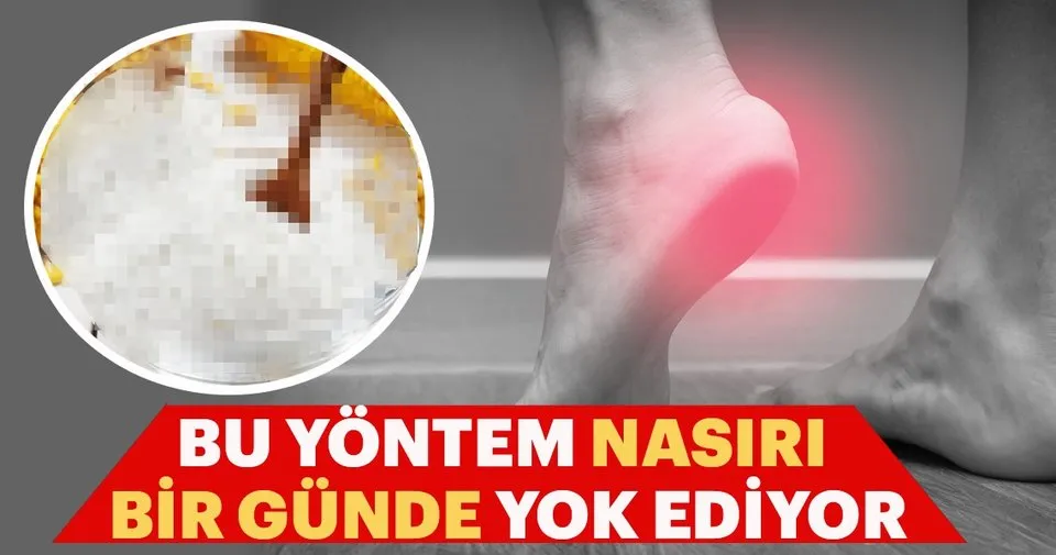 Nasiri 1 Gunde Gecirecek Tedavi Yontemleri Sayfa 4 Kadin Haberleri