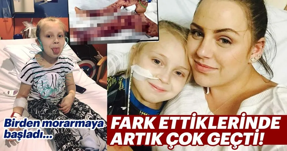 Birden morarmaya başladı... Fark ettiklerinde artık çok geçti! Birden morarmaya başladı... Fark ettiklerinde artık çok geçti!