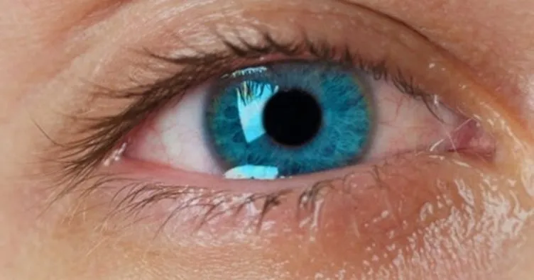 Göz sulanması neden olur? Nasıl tedavi edilir? - Sağlık Haberleri
