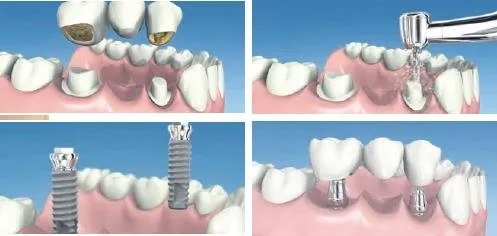 dental implant cerrahisi dis hekimi