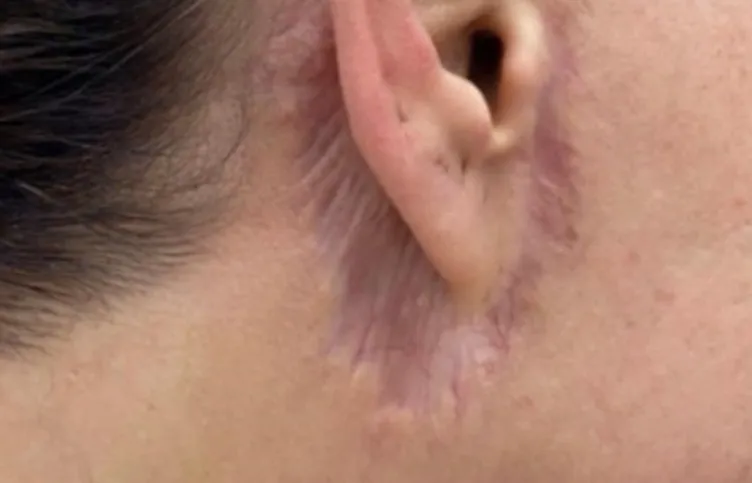 SON DAKİKA | Estetik ameliyatı genç kadının kabusu oldu: Kulağını kesip yüzünü diktiler