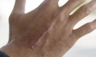 Vücutta oluşan yara izlerine dikkat!