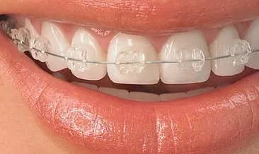 Diş Teli Kaç Yaşında Takılır? Yetişkinlikte Diş Teli Kaç Yaşına Kadar Takılabilir, Yaş Sınırı Var Mı?