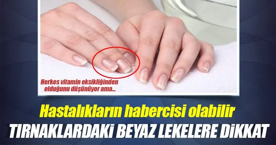 tirnaklardaki beyaz lekeler neden