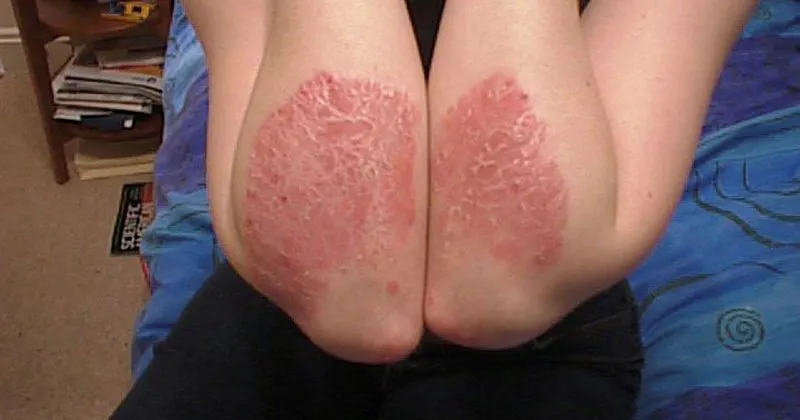 sedef hastaligi nedir belirtileri