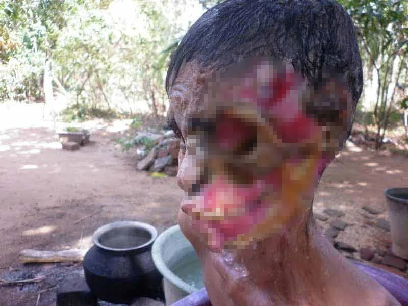 Et yiyen virüs kadının yüzünü yedi Son Dakika Haberler