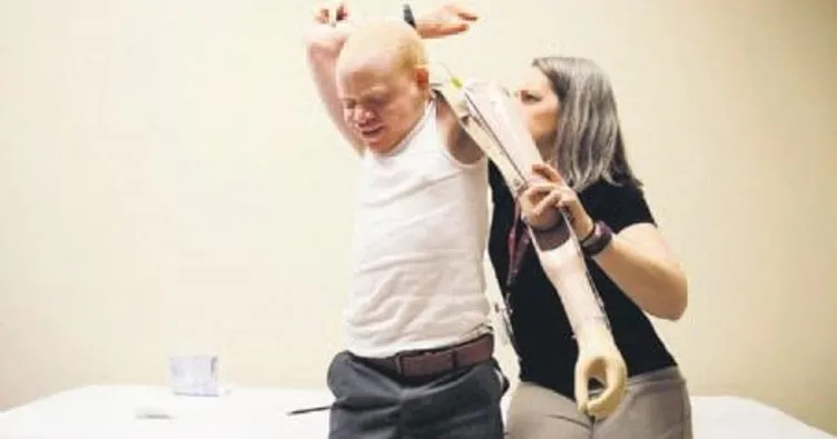 Albino çocuklar yeni uzuvlarına kavuştu