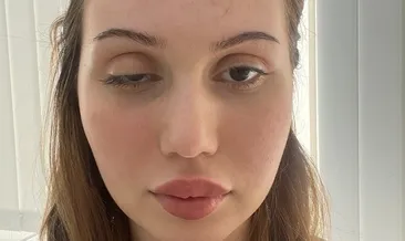 Merdiven altı botoks faciası