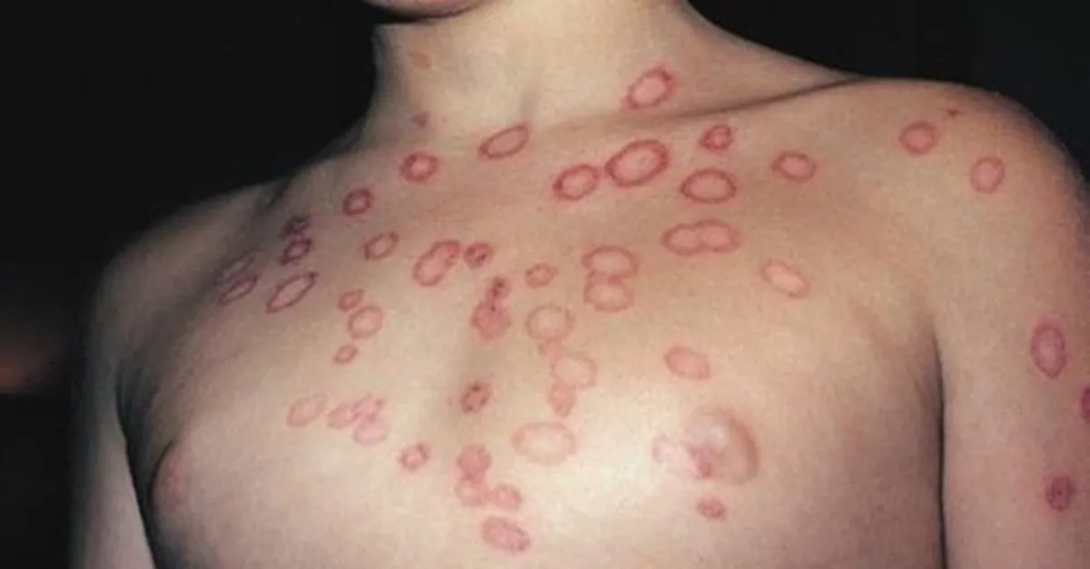 cilt mantari neden olur