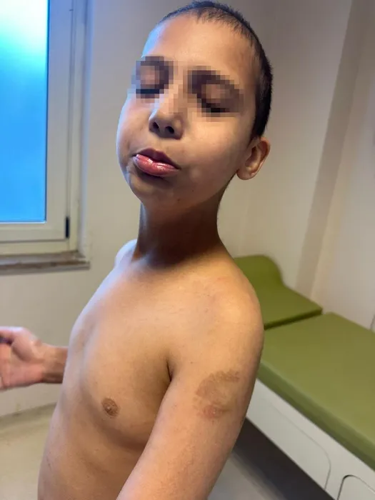 Özel bakım merkezinde otizmli çocuğa şiddet: Vücudu morardı! Beğenmiyorsanız kendiniz baksaydınız!