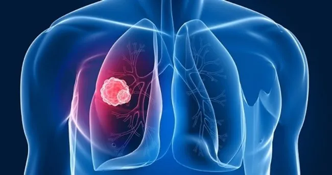 Akciğer Kanseri nedir? Belirtileri nelerdir?