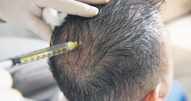 Acell PRP saç tedavisi ile etkili ve kalıcı çözüm