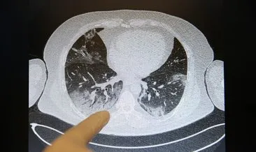 Kovid-19’un akciğerlere verdiği zarar tomografi görüntülerine yansıyor