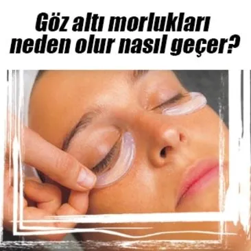 Goz Alti Morluklari Neden Olur Nasil Gecer Sanal Basin