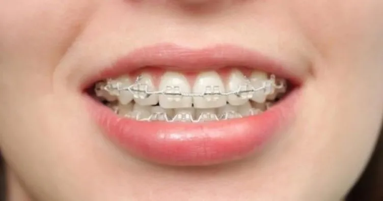 Diş telleri hakkında bilinmesi gerekenler nelerdir? Diş telleri nasıl takılır?