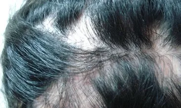 Saçkıran için doğal ve bitkisel tedavi yöntemleri! Saçkırana ne iyi gelir, neden olur ve nasıl tedavi edilir?