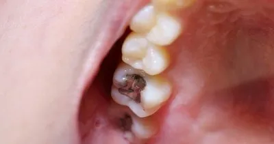 Çürük dişleri tedavi ettiği ortaya çıktı! Sağlıklı dişler için uygulanan bu yöntem şaşırtıyor...