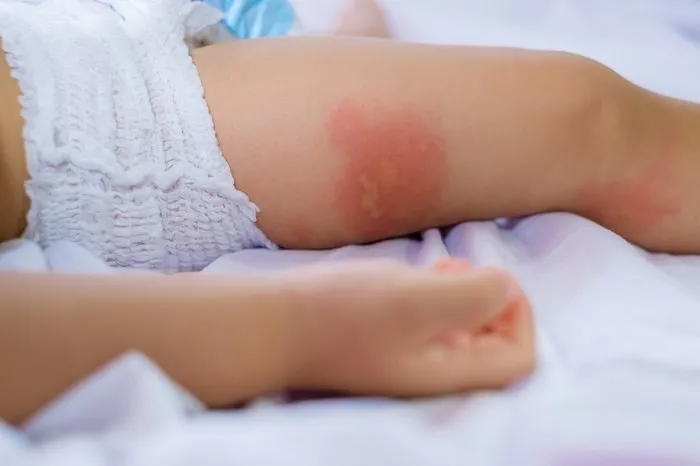 bebeklerde atopik dermatite karsi etkili oneriler bebek haberleri