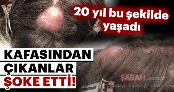 20 yıl bu şekilde yaşadı....Kafasından çıkanlar şoke etti!