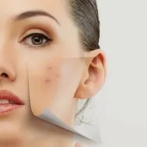 yuzdeki sivilce izleri nasil gecer