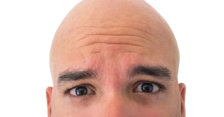 Saç ektirirken nelere dikkat edilmeli?