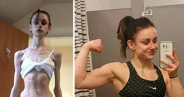 Anoreksiyayı yenen insanlar