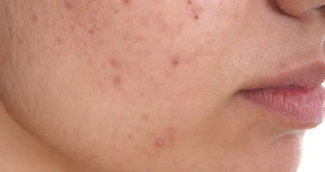 Kol Sivilceleri Icin 2 Kolay Maske Tarifi
