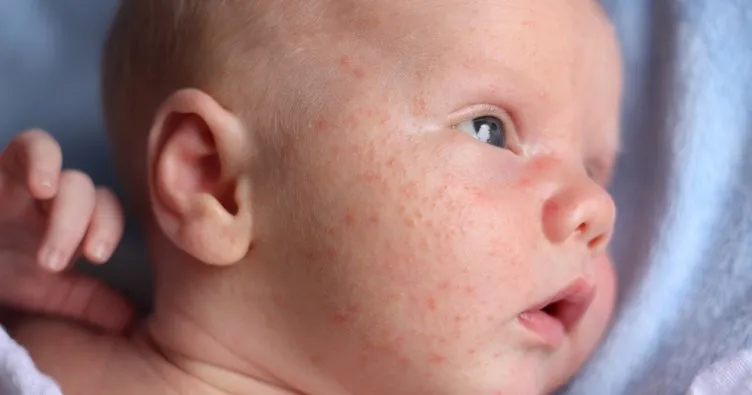 bebeklerin yuzundeki sivilce gibi kizariklik nasil gecer bebeklerin yuzunde cikan sivilceler neden olur bebek haberleri