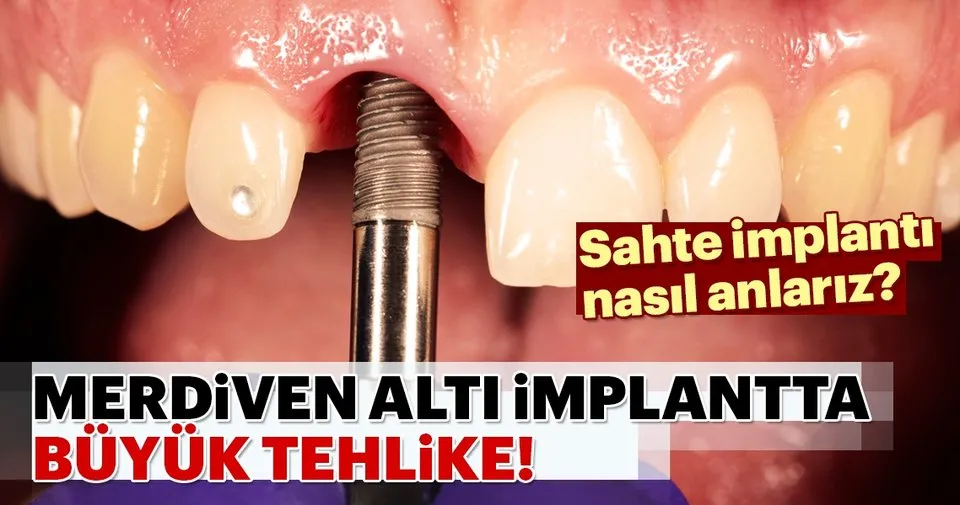 Merdiven altı implant tehlike saçıyor! Sağlık Haberleri