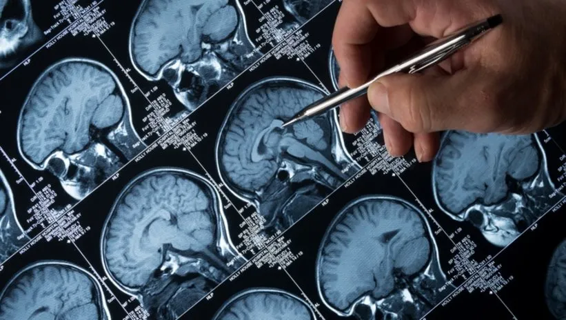 Alzheimer’ın en erken belirtisi! O kişilerin yüzde 47’sinde görülüyor...