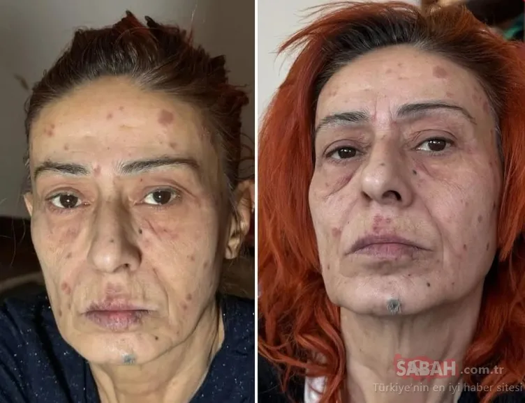 ‘Uyuduğu için yüzü yandı’ iddialarına cevap verdi! Tanyeli’nin gecesinde ortaya çıkan Yıldız Tilbe: Boya kötüymüş!