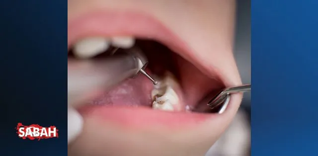 Diş hastalıkları kalbi vuruyor - Sağlık Haberleri | NTV