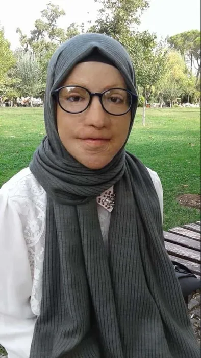20 yıllık zorlu mücadele ve mutlu son: 49 ameliyatla yeni yüz