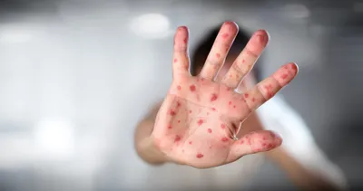 Kızamık nedir, belirtileri nelerdir, nasıl ve neden olur? Kızamık döküntüsü nasıl anlaşılır?