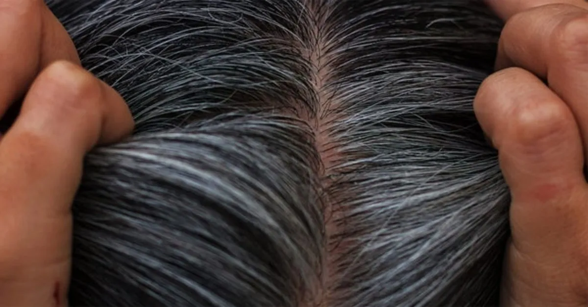 Sactaki Beyazlar Dogal Ve Bitkisel Yollar Ile Kapanir Mi Sactaki Beyazliklardan Kurtulmanin Dogal Ve Bitkisel Yollari Son Dakika Yasam Haberleri