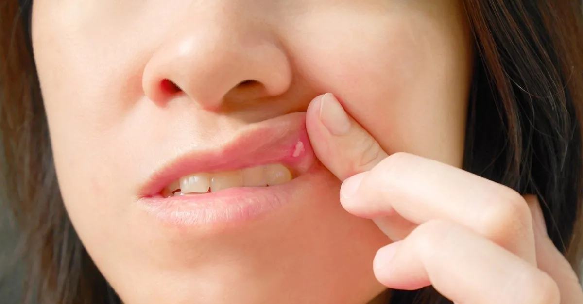 ★ Kedilerde ağız yarasına ne iyi gelir ★ Kedilerde ağız yarasına ne iyi gelir