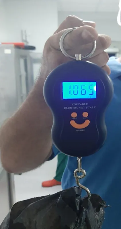 agri-sikayetiyle-gitti-mesanesinden-1-kilogramlik-tas-cikarildimesaneden-cikan-dev-tasa-doktorlar-bile-inanama-1723107192730.jpg