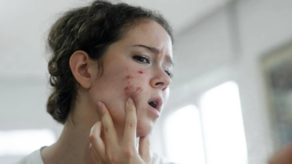 Anne sözü mü bilimsel gerçek mi? Çikolatanın sivilce yaptığı iddiasına son nokta koyuldu! Anne sözü mü bilimsel gerçek mi? Çikolatanın sivilce yaptığı iddiasına son nokta koyuldu!