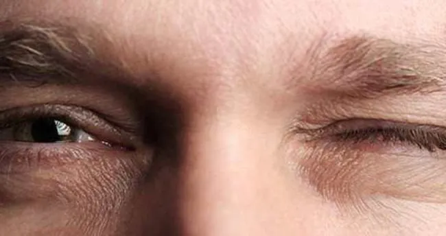goz seyirmesi nedenleri goz segirmesi neden olur saglik haberleri