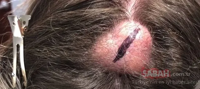 20 yıl bu şekilde yaşadı....Kafasından çıkanlar şoke etti!