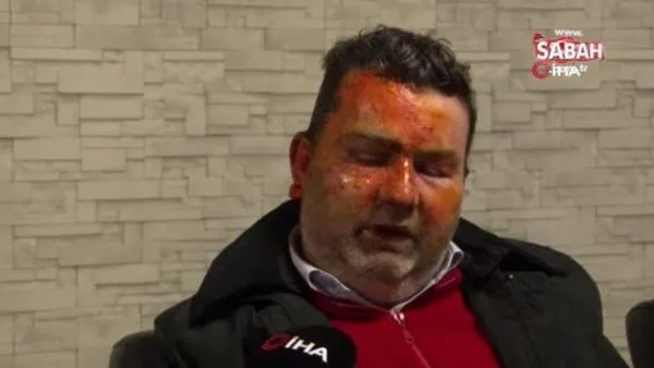 Uyurken dehşeti yaşadı: Kardeşi tarafından yüzünün yakıldığını iddia etti | Video