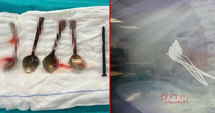 Kayseri’de akılalmaz olay: Doktorlar şaşkına döndü! Hepsi 15 yaşındaki çocuğun midesinden çıktı