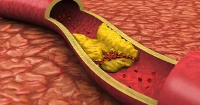 Ateroskleroz damar sertliği nedir, belirtileri, tedavisi