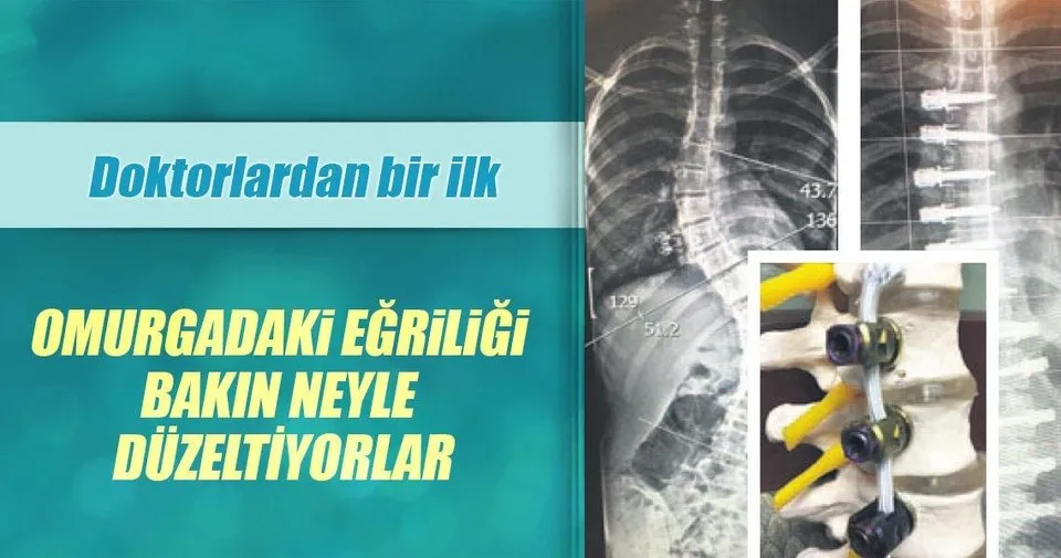 Omurgasini Iple Duzelttiler Son Dakika Haberler