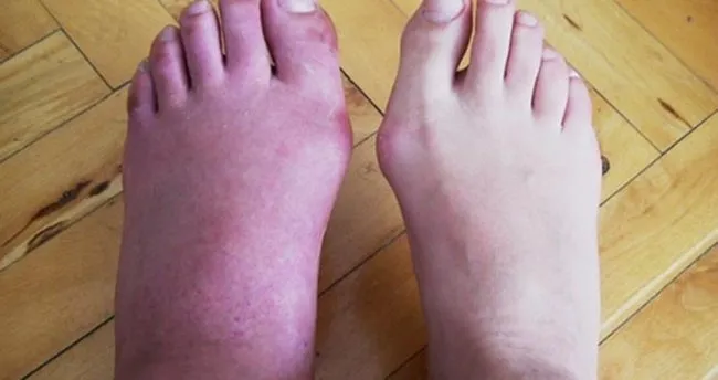 ayak sismesinin nedenleri nelerdir