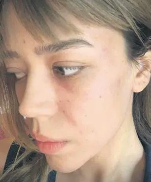 Eski eşten Özcan Deniz’e darp suçlaması! Fotoğrafları ilk kez ortaya çıktı
